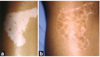 Non-Cultured Melanocyte Transplant