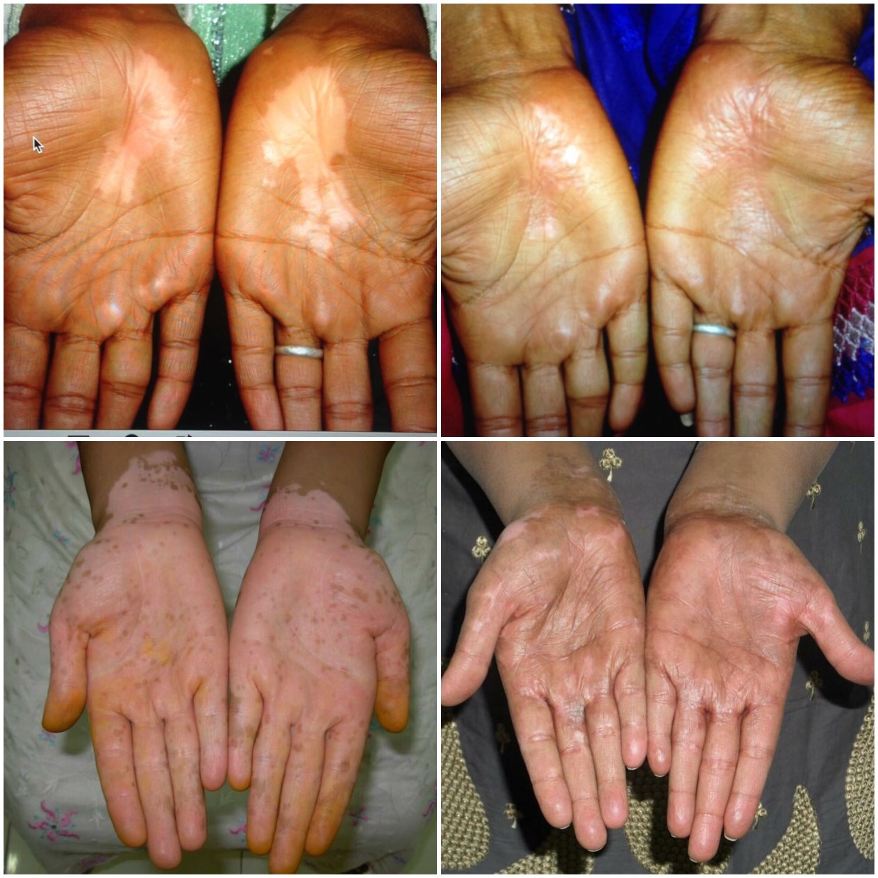 Again we conquer palmer vitiligo