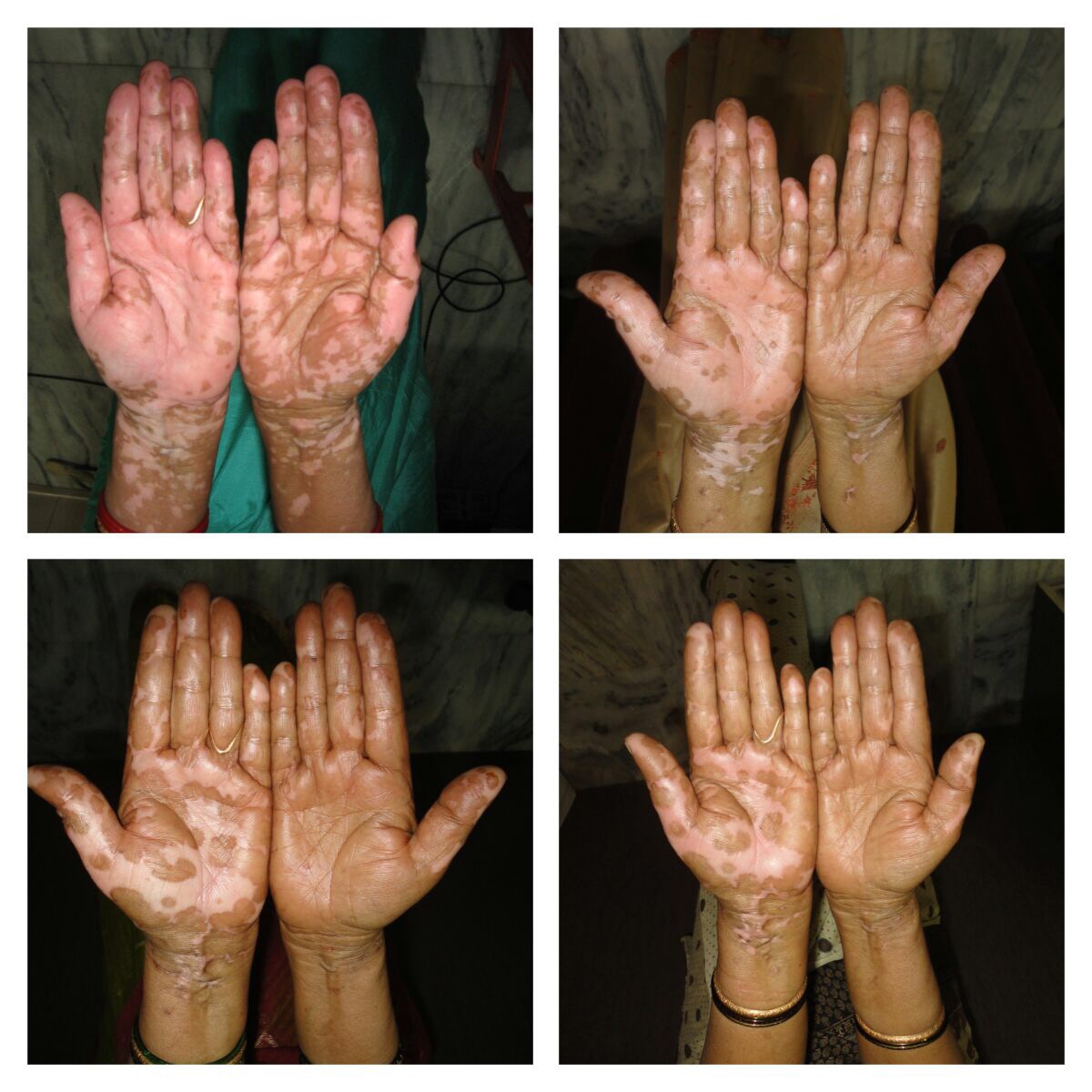 Successful story in Vitiligo