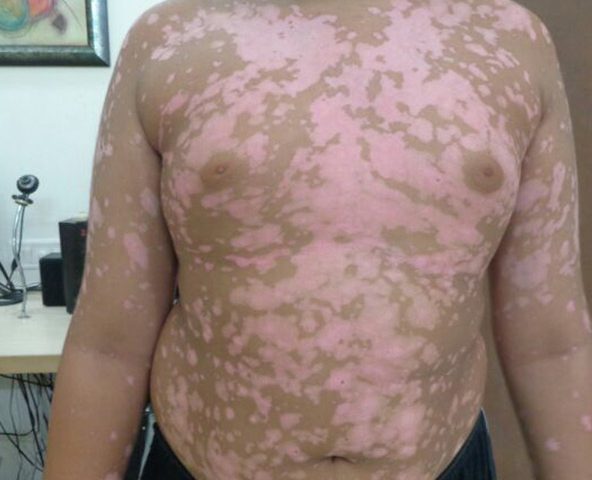Again a super success story – Case of Maharshi Vitiligo Centre, Mumbai