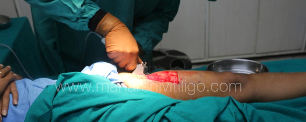 Vitiligo in India now easy to treat with Melanocyte Transplant