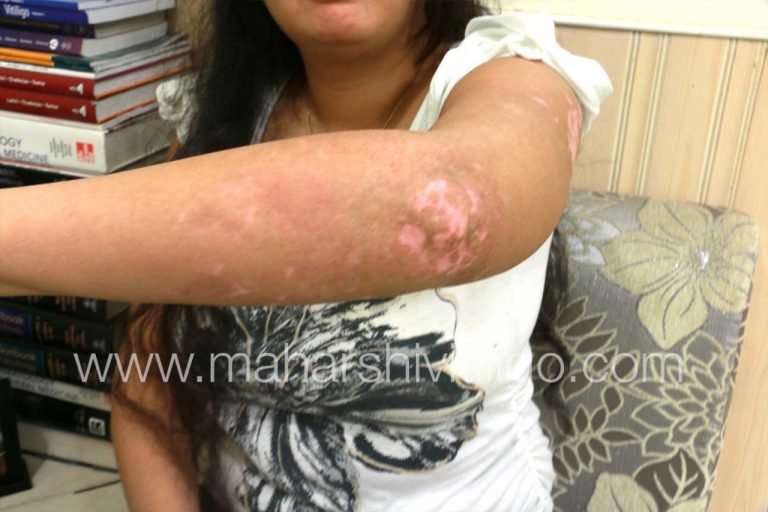 Non-cultured melanocyte transplant for young vitiligo patient from Mumbai