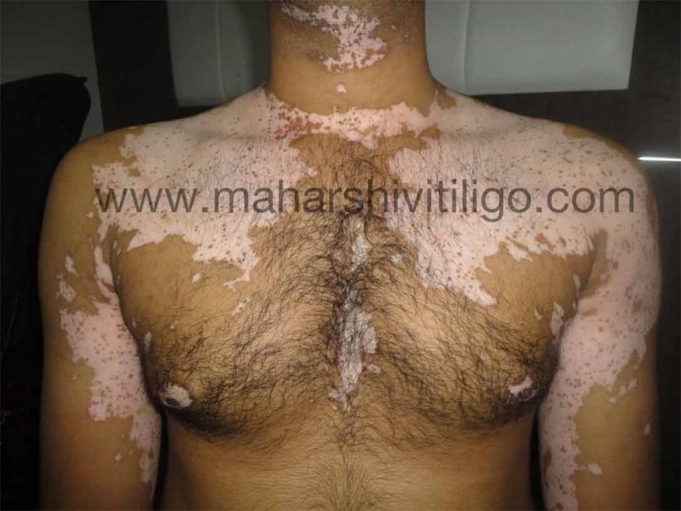 Genuine advice to vitiligo patient to get faster recovery from white patch treatment in India.