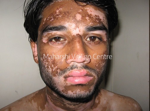 Vitiligo Centre Indore - Before