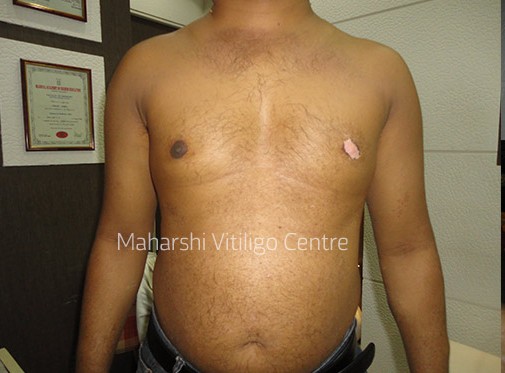 Vitiligo Centre Indore - After