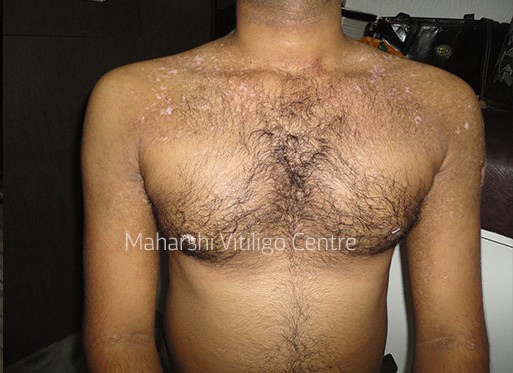Vitiligo Centre Indore - After