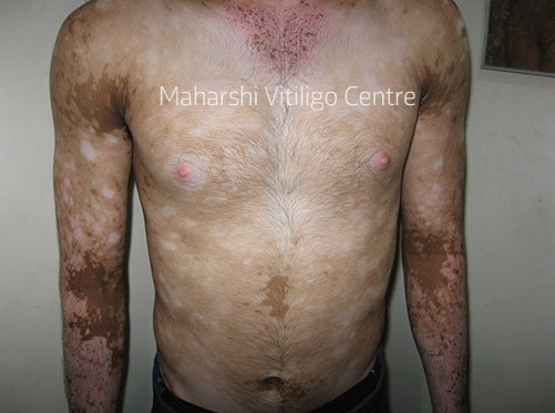 Vitiligo Centre Indore - Before