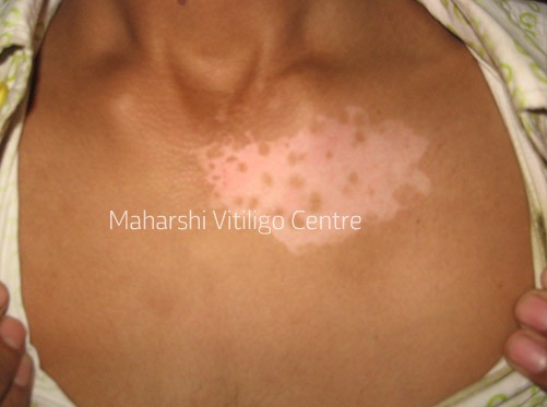 Vitiligo Centre Indore - Before
