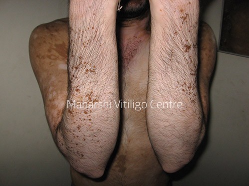 Vitiligo Centre Indore - Before