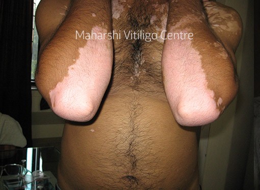 Vitiligo Centre Indore - Before