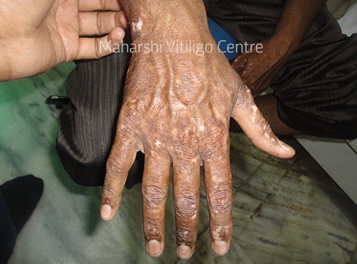 Vitiligo Centre Indore - After