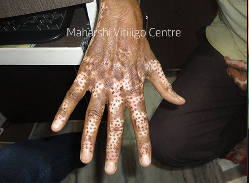 Vitiligo Centre Indore - Before
