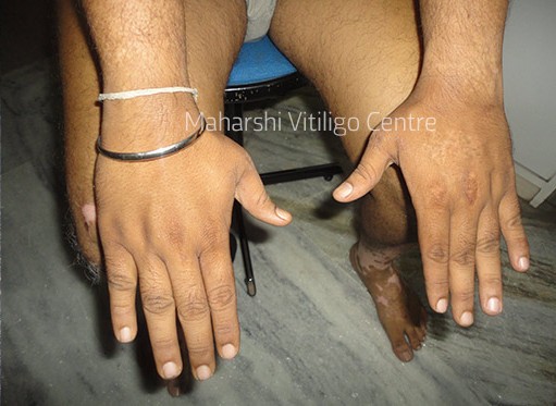Vitiligo Centre Indore - After