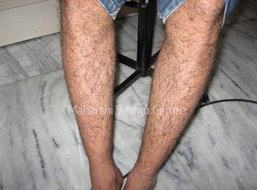 Vitiligo Centre Indore - After