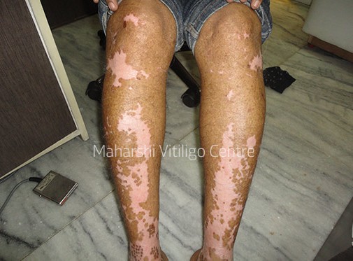Vitiligo Centre Indore - After