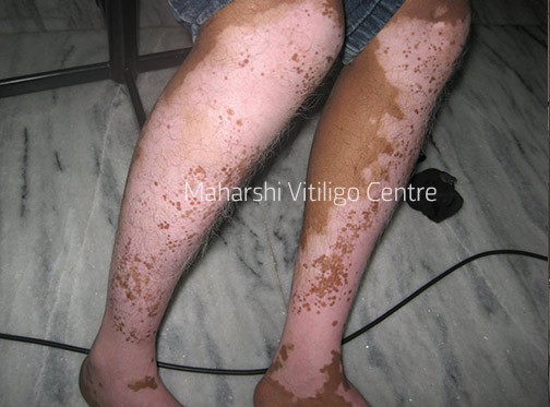 Vitiligo Centre Indore - Before