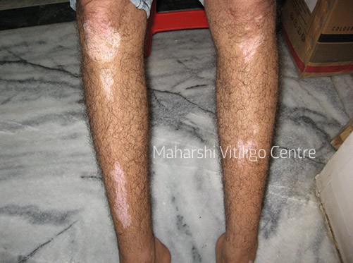 Vitiligo Centre Indore - Before