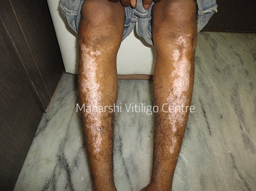 Vitiligo Centre Indore - Before