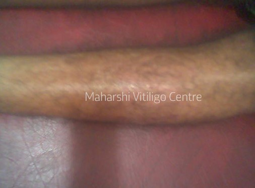 Vitiligo Centre Indore - After