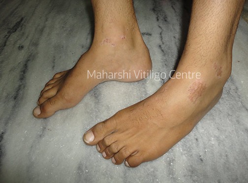 Vitiligo Centre Indore - After