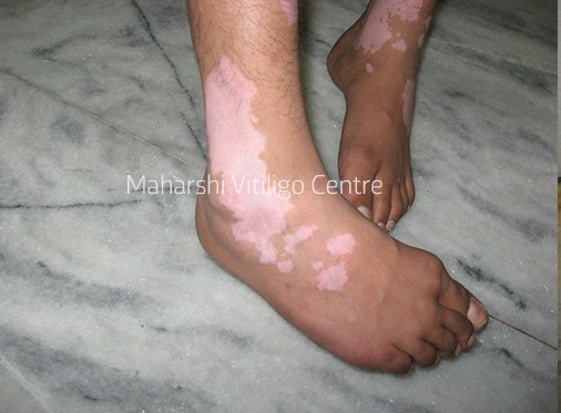 Vitiligo Centre Indore - Before