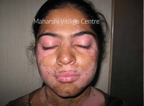 Vitiligo Centre Indore - Before