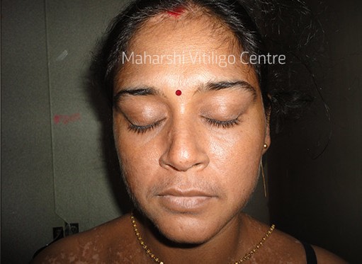 Vitiligo Centre Indore - After