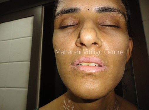 Vitiligo Centre Indore - After