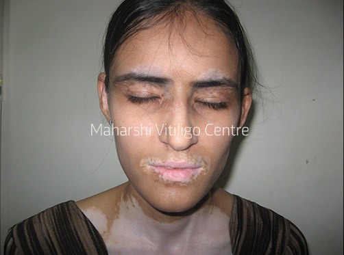 Vitiligo Centre Indore - Before