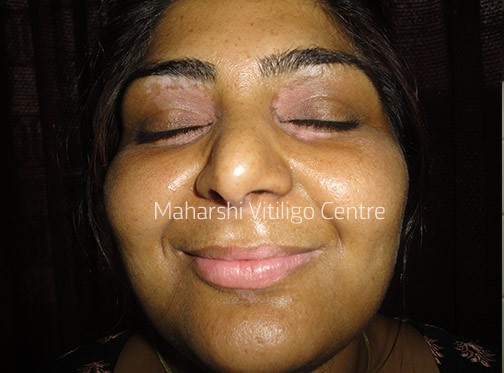 Vitiligo Centre Indore - Before