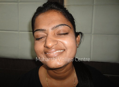Vitiligo Centre Indore - After