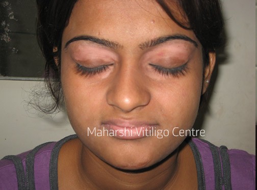 Vitiligo Centre Indore - Before