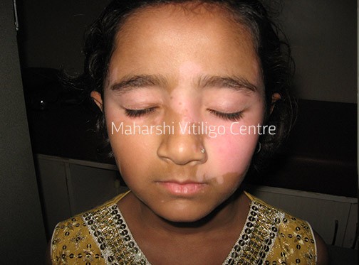 Vitiligo Centre Indore - Before