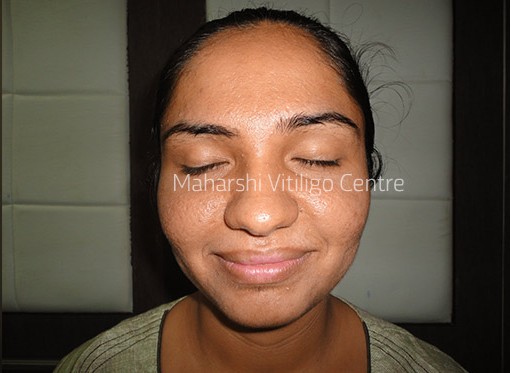 Vitiligo Centre Indore - After