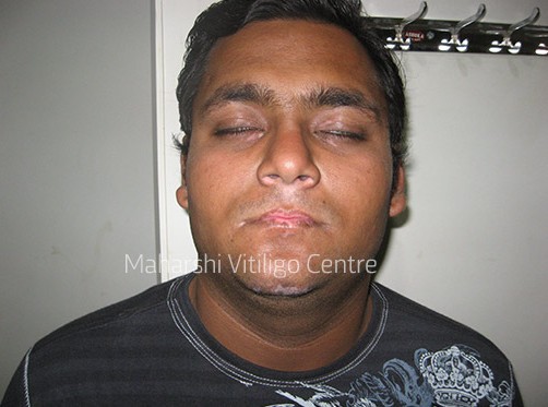 Vitiligo Centre Indore - After