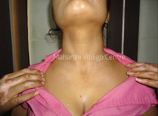Vitiligo Centre Indore - After
