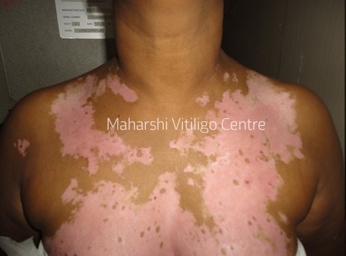 Vitiligo Centre Indore - Before