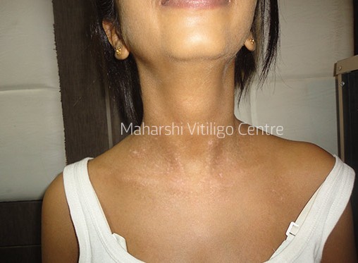Vitiligo Centre Indore - After