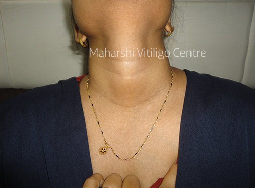 Vitiligo Centre Indore - After
