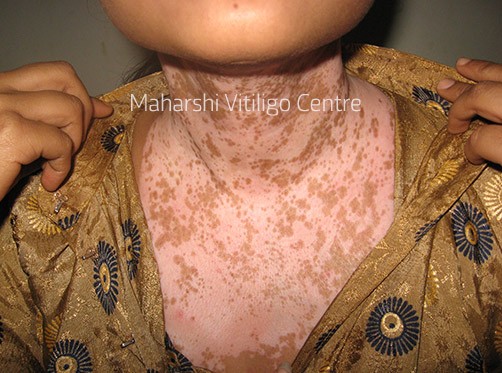 Vitiligo Centre Indore - Before