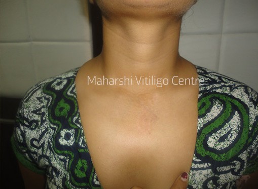 Vitiligo Centre Indore - After