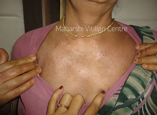 Vitiligo Centre Indore - After