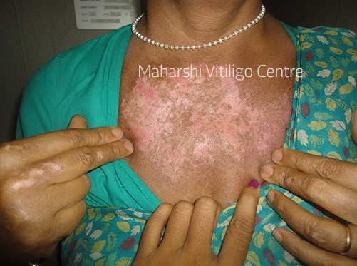 Vitiligo Centre Indore - Before
