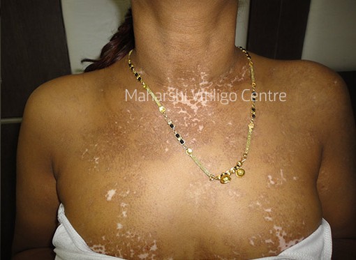 Vitiligo Centre Indore - After