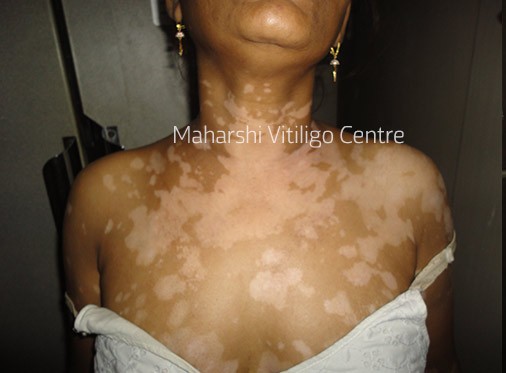 Vitiligo Centre Indore - Before