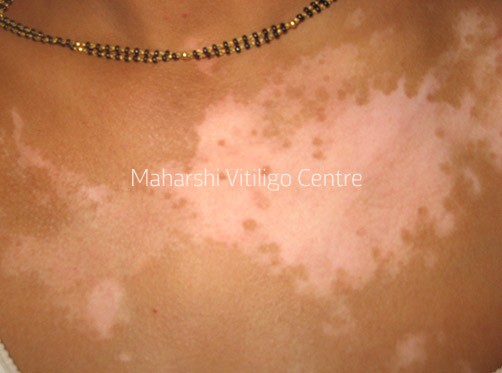 Vitiligo Centre Indore - Before