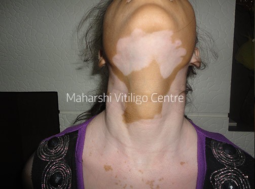 Vitiligo Centre Indore - Before