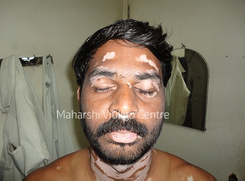 Vitiligo Centre Indore - Before