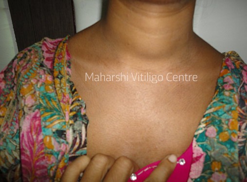Vitiligo Centre Indore - After