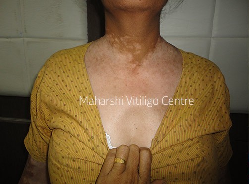Vitiligo Centre Indore - Before